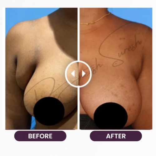 Breast Reduction (1)