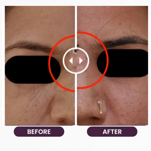 Breast Reduction (10)