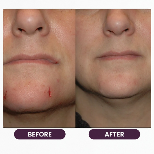 Breast Reduction (11)