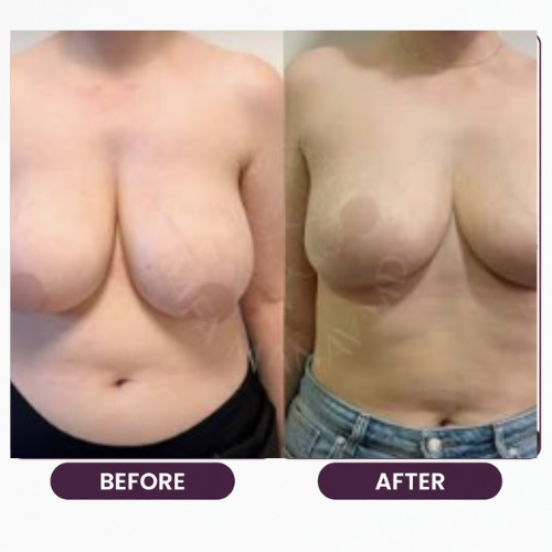 Breast Reduction (2)