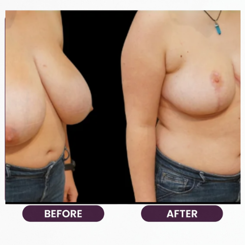 Breast Reduction (3)