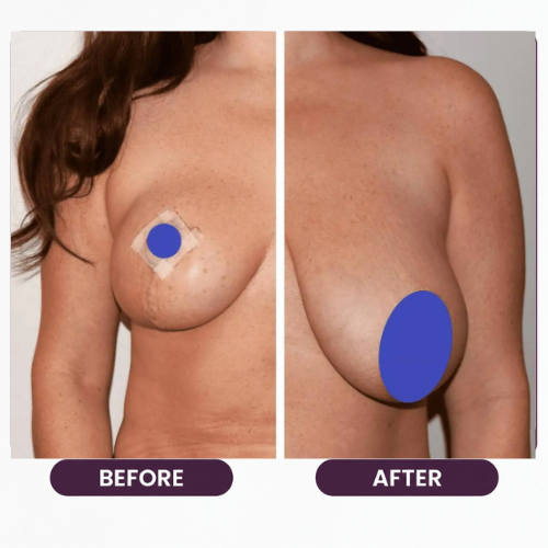 Breast Reduction (4)