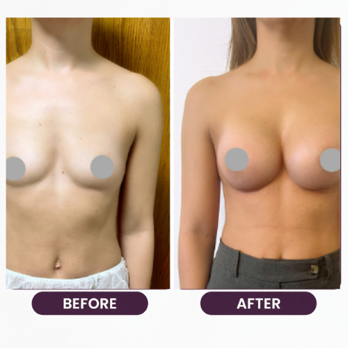 Breast Reduction (5)