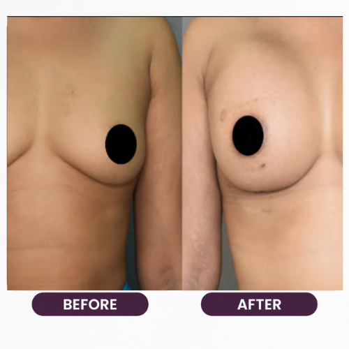 Breast Reduction (6)