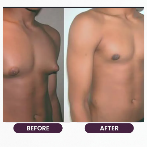 Breast Reduction (7)