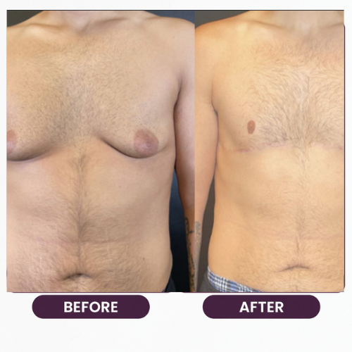 Breast Reduction (8)