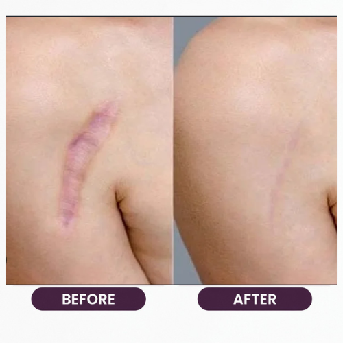 Breast Reduction (9)