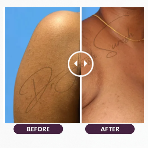 Breast Reduction